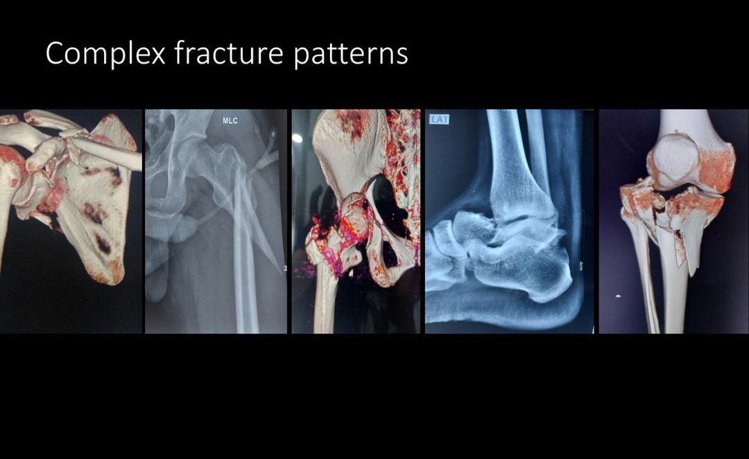 Complex Trauma and Pelvic Acetabular Injuries in Delhi