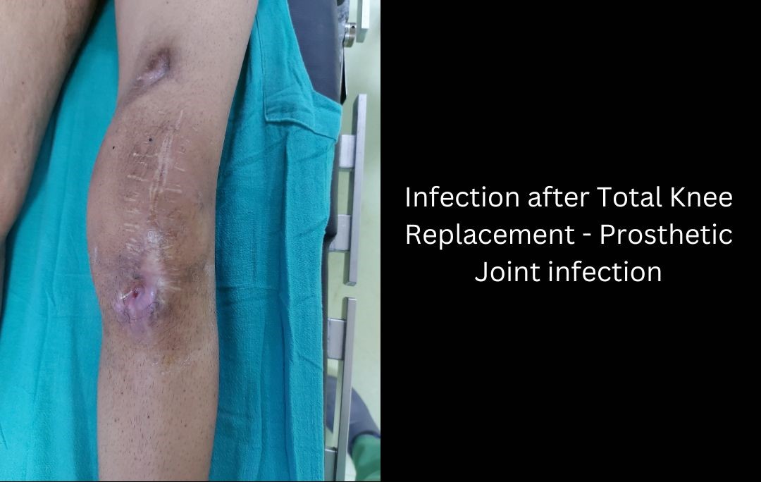 Bone and Joint Infections Treatment in Delhi