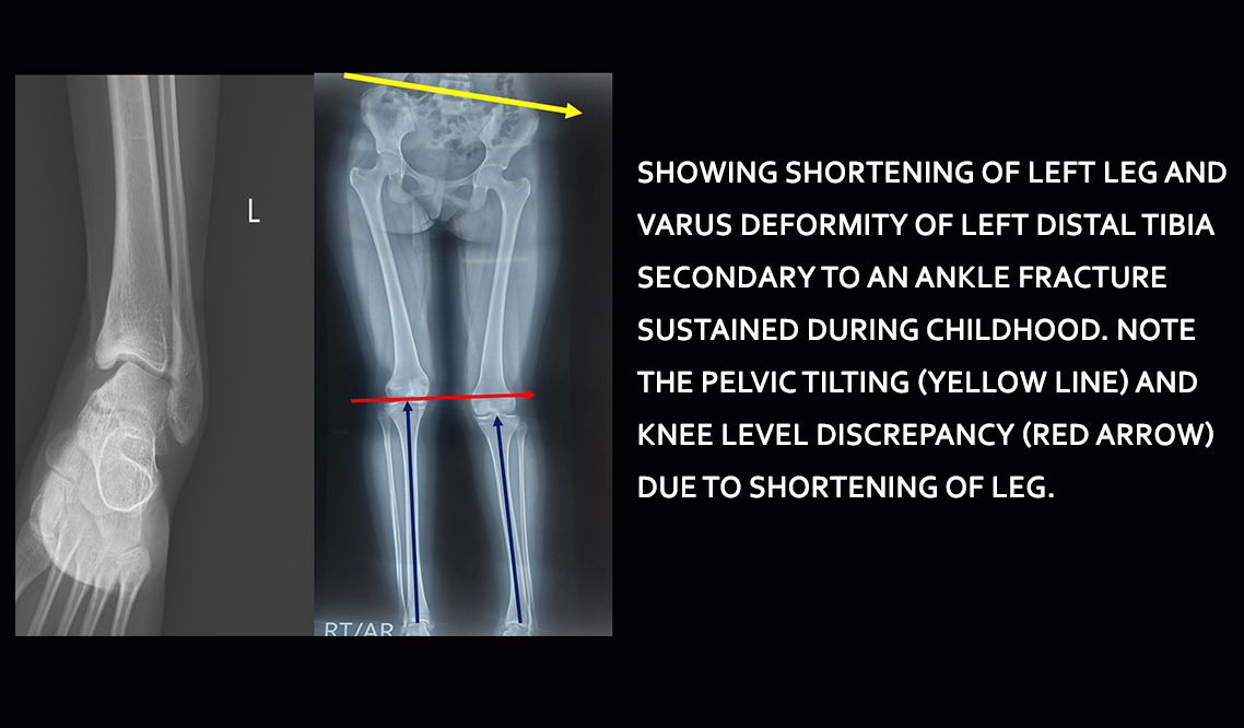 Limb Lengthening in Delhi