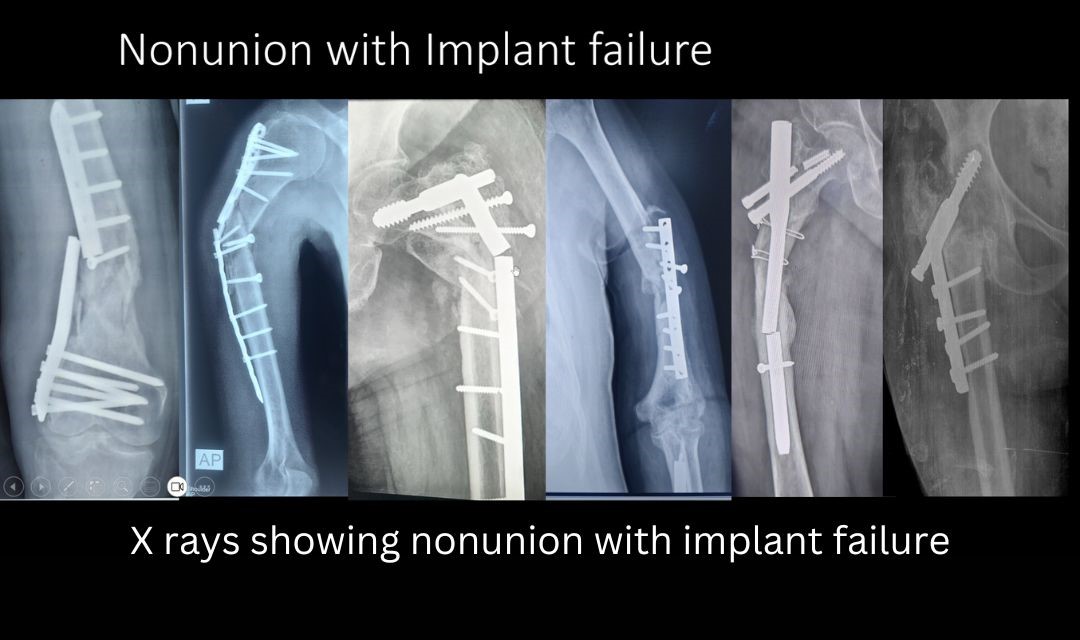 Nonunion and Management of Bone loss Treatment in Delhi